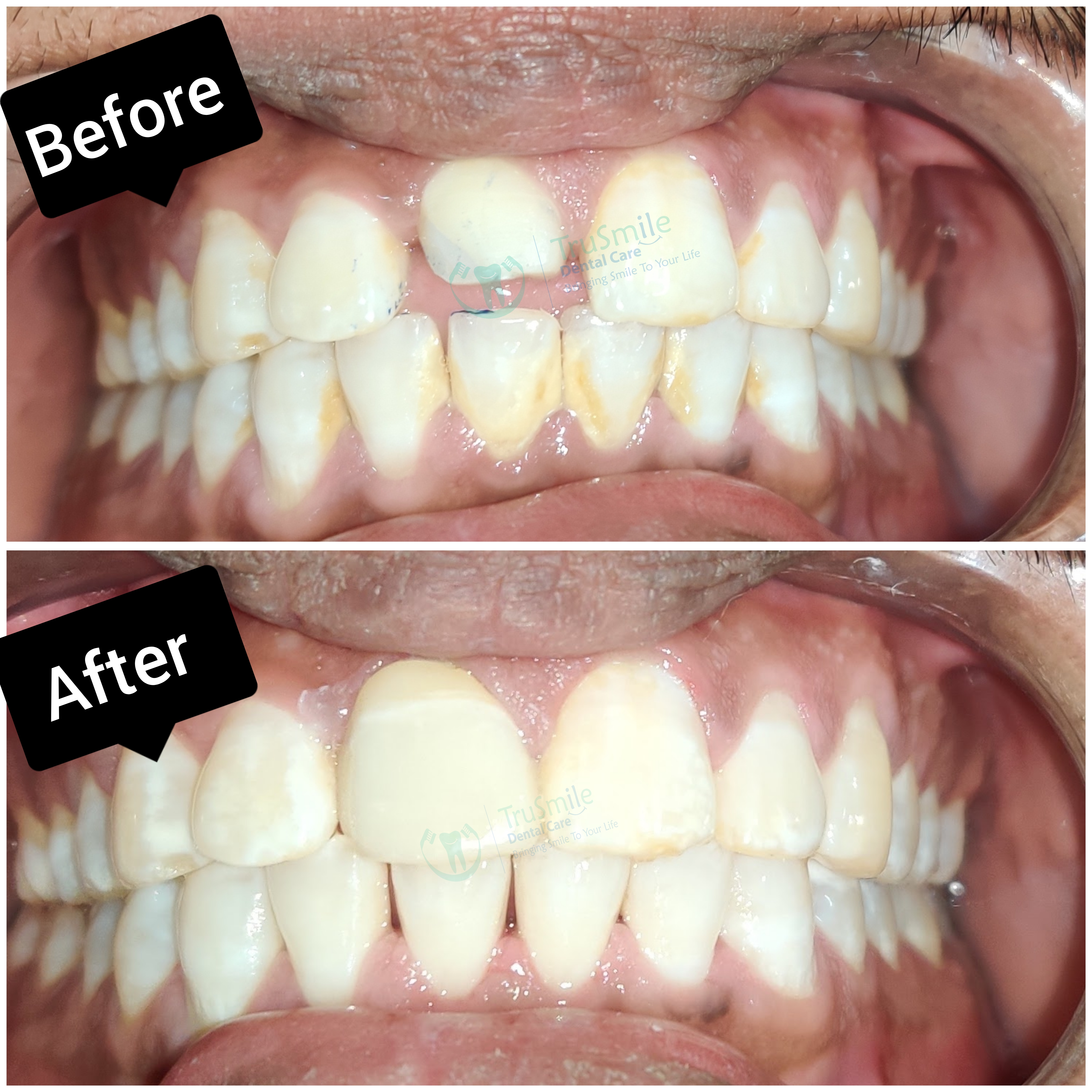 Zirconia 7